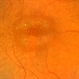 Cone Dystrophy